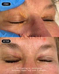 Image result for xantelasma