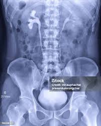 Image result for Intravenous Pyelogram
