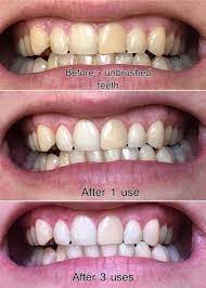 We've already established that charcoal toothpastes without fluoride can put your teeth at risk of developing . 19 Teeth Whiteners That Work So Well It S Basically Magic