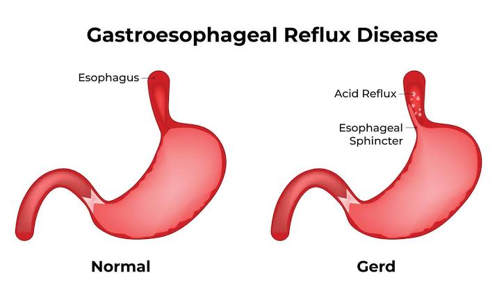 gerd gastro-oesofageale reflux zuur Aan geduldig maag. spijsvertering  wanorde oorzaken geduldig maagzuur pijn of zuur reflux indigestie. medisch  en gezondheidszorg. 3d vector. 27517949 Vectorkunst bij Vecteezy