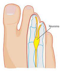 Mortons Neuroma Columbia Neurosurgery
