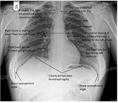 Living anatomy of the chest for 1st year medical students original version compiled by dr. A Normal Pa Chest X Ray Demonstrating The Normal Anatomy Download Scientific Diagram