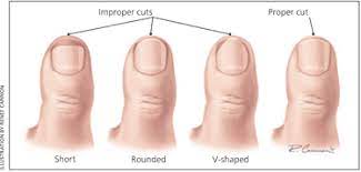 Ingrown toenails can be painful and cutting them the wrong way can make the problem even worse. Management Of The Ingrown Toenail American Family Physician