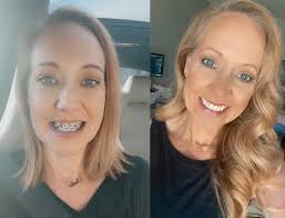 Invisalign Adult Clear Aligners Help OKC Teacher Smile