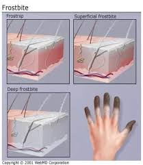 Image result for Frostbite