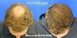 Day one after hair transplant surgery. Hair Transplant Crown Area A Complete Guide To Crown Hair Transplants