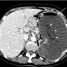 Image result for Splenic Abscess