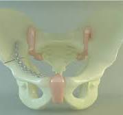 The model of anterior column plate fixation. | Download ...