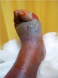 The symptoms can be mild, or they can leave you very. Complicated Skin Skin Structure And Soft Tissue Infections Are We Threatened By Multi Resistant Pathogens European Journal Of Medical Research Full Text