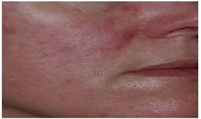 Browse our listings to find jobs in germany for expats, including jobs for english speakers or those in your native language. Scielo Brasil Dermocosmetic Care For Rosacea Dermocosmetic Care For Rosacea