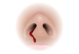Effective Management of Epistaxis - SciTeMed Publishing Group