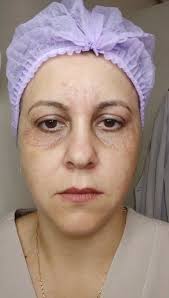 ✨Jato de plasma🖋️, Procedimento com doses fracionadas de plasma  propiciando mais controle, precisão e segurança aos tratamentos estéticos.,  Plasma é rico em íons e elétrons livres, esse estado é ...