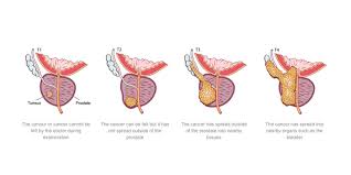 More advanced prostate cancers can sometimes cause symptoms, such as: Prostate Cancer Treatment Diagnosis In India Rg Stone Hospital