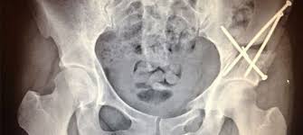 A Full Disclosure Telling Of My Pao Surgery And The Recovery Process Surgery Recovery Blog Surgery Recovery