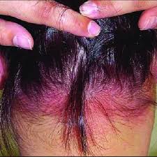 Once you develop allergy this dye, changing brand may not help. Result Of Treatment With Intravenous Corticosteroids The Allergy Download Scientific Diagram