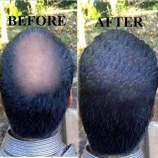 Massaging these oils on bald areas invigorates the scalp. Buy Bald Head Oil Cure Baldness Hair Regrowth Oil Online Best Prices In India Rediff Shopping