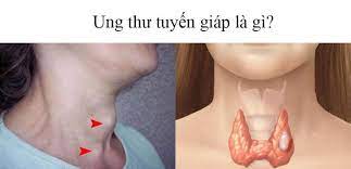Hoàng khuyến cáo khi đã phát hiện bệnh lý tuyến giáp bướu nhân. Ung ThÆ° Tuyáº¿n Giap Nguyen Nhan Triá»‡u Chá»©ng Va PhÆ°Æ¡ng Phap Ä'iá»u Trá»‹