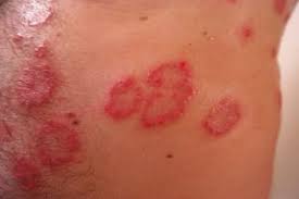 Image result for dermatitis contacta allergica