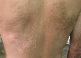 Check spelling or type a new query. Graue Flechten Haufige Anzeichen Fur Das Auftreten Von Flechten Diagnose Und Behandlung Von Gurtelrose