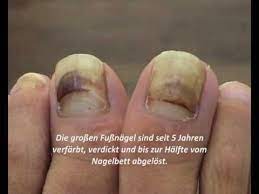 gelbliche zehennagel dicker fussnagel fussnagel richtig schneiden youtube fussnagel richtig schneiden fussnagel dicke fussnagel