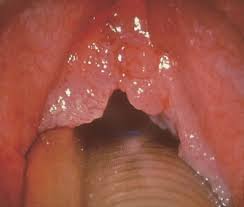 How do you check yourself for throat cancer? Larynx Tumor An Overview Sciencedirect Topics