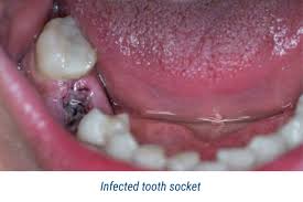 Image result for Alveolitis sicca)