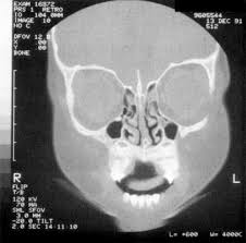 Image result for Sinus CT