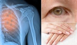 The presence of these symptoms doesn't definitively mean you have lung cancer, though, as they can also be caused by other conditions. Lung Cancer Symptoms Five Surprising Warning Signs Of A Tumour You May Be Ignoring Express Co Uk
