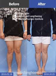 Tungkai kaki terdiri dari dua tulang: Kaki X Limb Lengthening Complex Reconstruction Service Korea Dalri