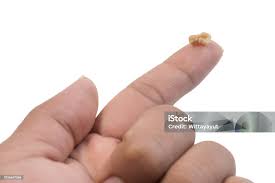 Image result for Tonsillolith