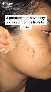 How To Get Rid Of Acne Skincare Hacks Video In 2020 Skin Care Acne Face Skin Care Clear Skin Tips