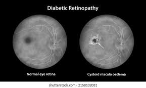 Image result for Edema Exam
