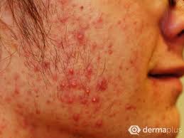 Check spelling or type a new query. Akne Akne Vulgaris Ursachen Und Die Richtige Therapie