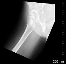 Laparoscopic understanding of pelvic anatomy and its application in benign and radical pelvic surgery. Assessment Of The Young Adult Hip Joint Using Plain Radiographs Springerlink