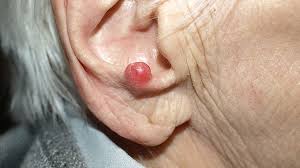Image result for Merkel Cell Carcinoma