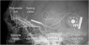 They are also called tdds (telephone devices for the a system of reading and writing using raised dots, which enables blind people to read by touch. Electronic Retinal Implant Surgery Eye