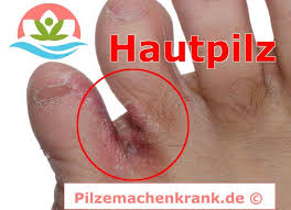 Hautpilz Mykose Pilzkrankheiten Info Mykoseguide Info Hier