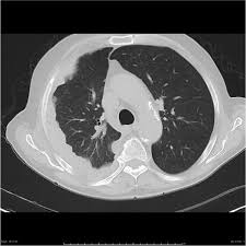Maybe you would like to learn more about one of these? Mesothelioma Radiology Case Radiopaedia Org