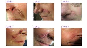 The american college of mohs surgery provides information for physicians and patients. Mohs Surgery Photos Before After Adc Derm