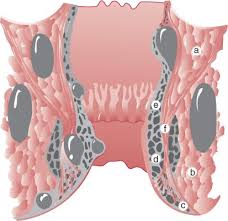 Image result for Ischiorectal Abscess