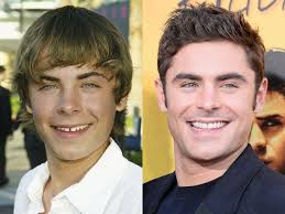 When you have gaps between front teeth after braces, you may consider having a veneer crown or composite filling. Celebrities Who Have Closed Their Gap Teeth