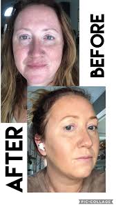 Creme makeup for rosacea and melasma coverage