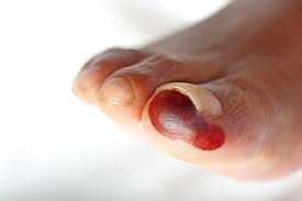 Image result for toe black diabetes