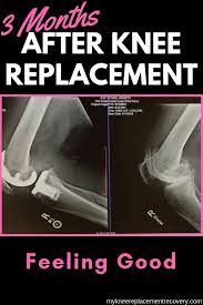Wow 3 Months Have Gone By After My Total Knee Replacement Surgery And I M Feeling Knee Replacement Surgery Recovery Knee Replacement Surgery Knee Replacement