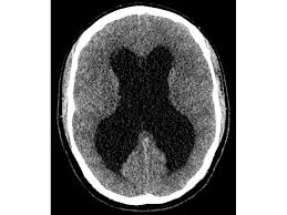 Image result for Hydrocephalus