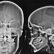 Fatal damage to the brain may occur without any fracture of the skull. Three Examples Of Blunt Force Trauma To The Skull A And B Are Download Scientific Diagram