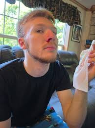 Nose bleeds after cleaning conex box