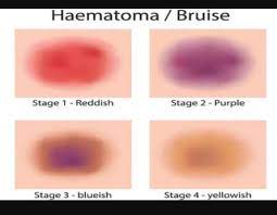Ways To Eliminate Hickeys By Way Of The Zodiac Ways To Get Rid Of A Hickey Asap Blue Waffles Disease And In Men Disorder A Ready Made Help Guide To