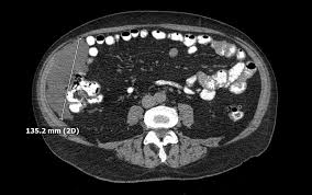 Standard imaging tests, including ultrasonography and helical computed tomography (ct) scans, are notably insensitive for the detection of peritoneal tumors. Cureus Benign Multicystic Peritoneal Mesothelioma Presenting As A Colonic Mass