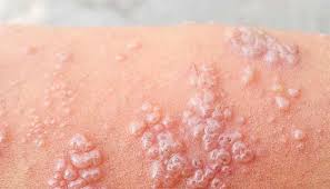 Tight clothing could also cause friction. Dermatitis Herpetiformis Johns Hopkins Medicine